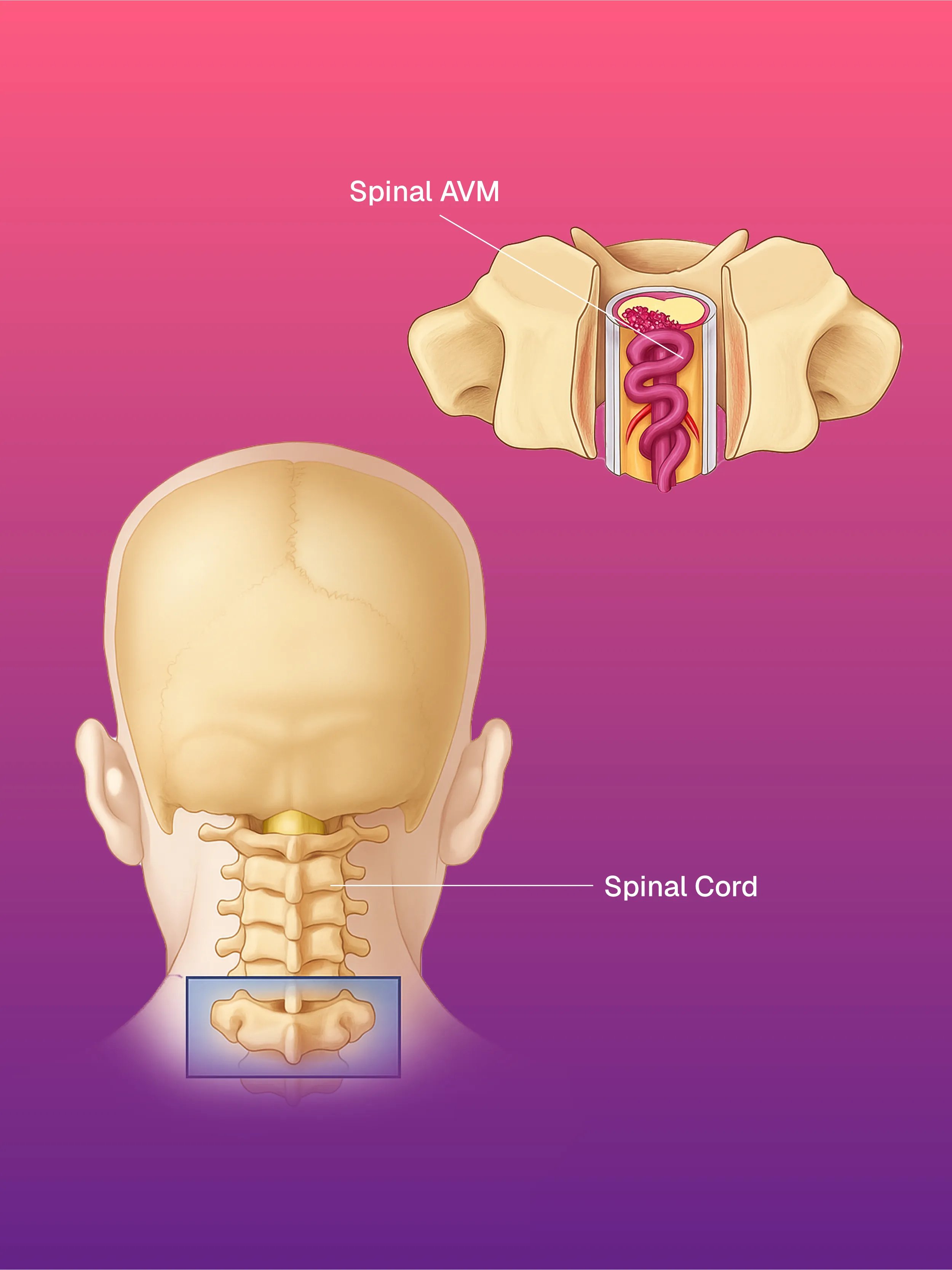 Brain & Spinal AVM/AVF Embolization Treatment | IR Clinic