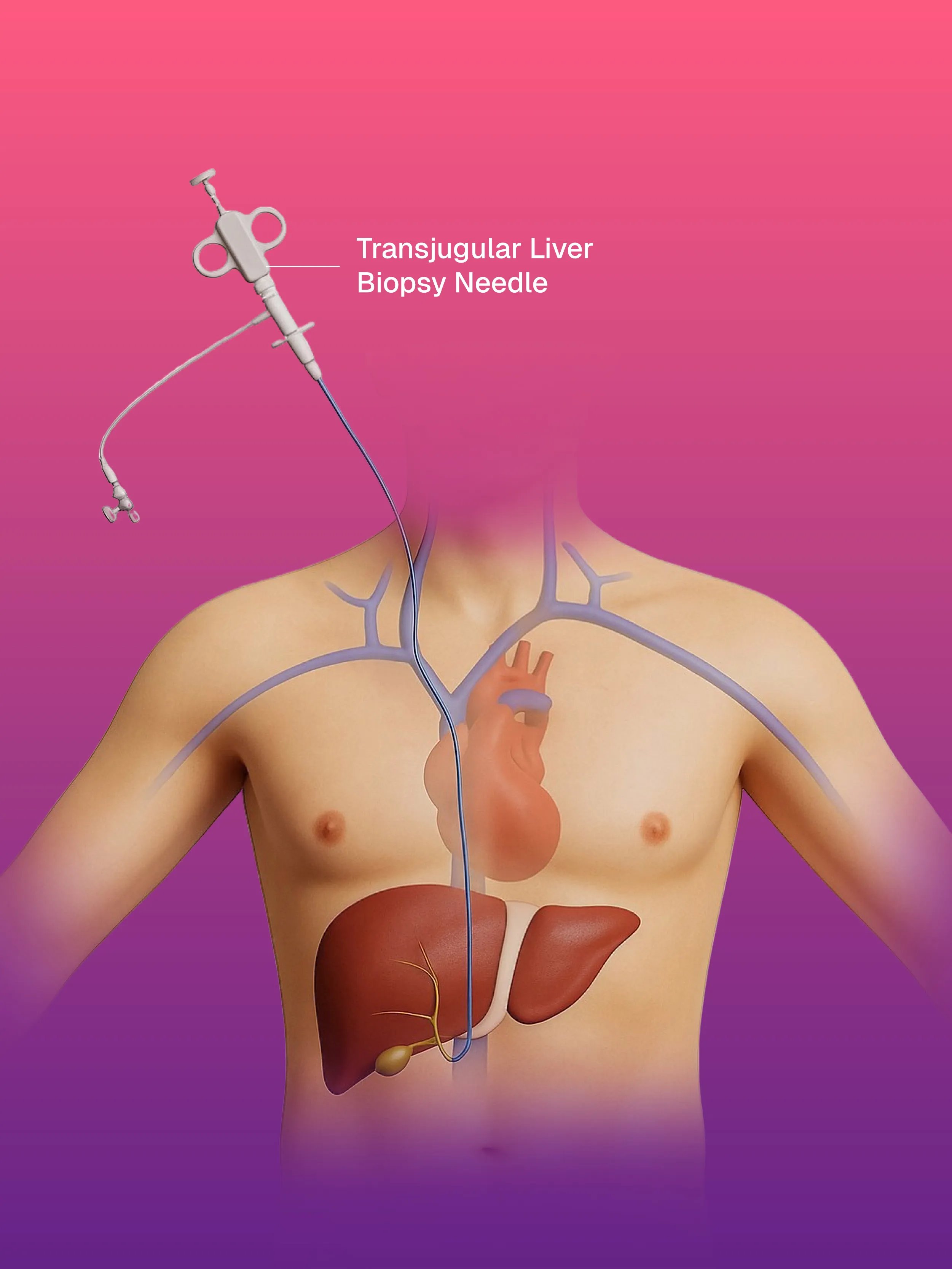 TJLB | Trans Jugular Liver Biopsy for Liver Disease Diagnosis